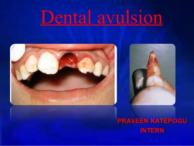 Avulsed Tooth