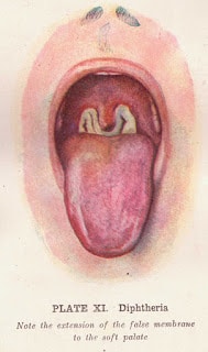 Diphtheria: Causes; Treatment And Care Of The Patient