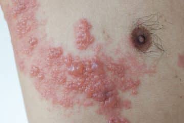 Herpes Zoster
