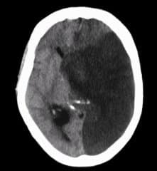 Midline Brain Shift - Healthsoothe