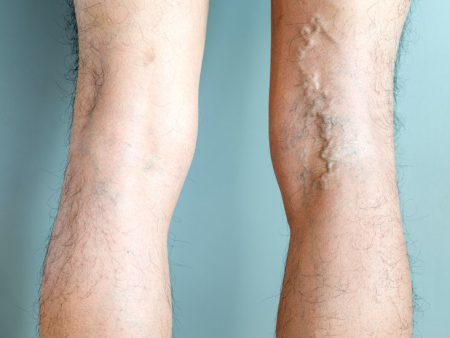 Behind The Scenes: The Work Of Vein Doctors