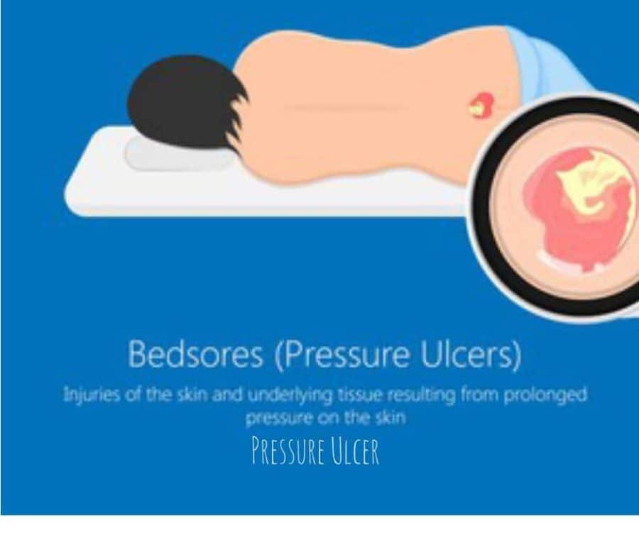 Pressure Ulcer Risk Assessment Vs. Clinical Judgment