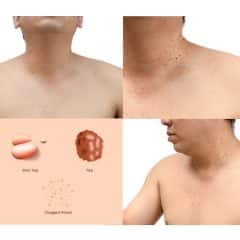 Skin Tags