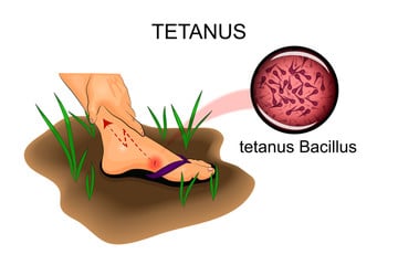 Tetanus