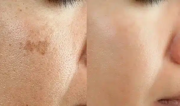 Hydroquinone Is An Effective Treatment For Age Spots